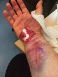 2023-05-11 carpal tunnel