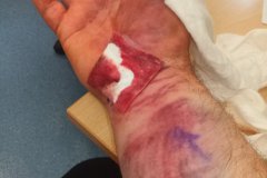 2023-05-11 carpal tunnel