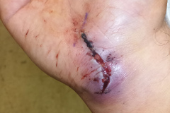 IMG_20230519_085712Z_QA_wound