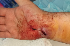 IMG_20230520_130533Z_QA_wound