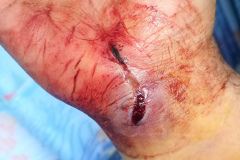 IMG_20230520_130555Z_QA_wound
